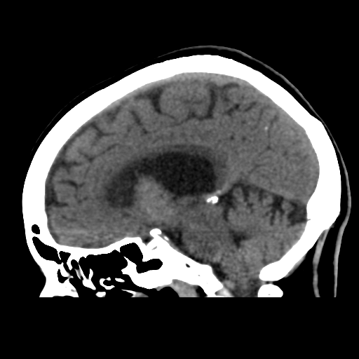 Central neurocytoma (Radiopaedia 65317-74346 C 26).png