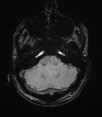 File:Central neurocytoma (Radiopaedia 71068-81303 Axial SWI 9).jpg