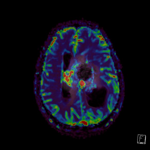 Central neurocytoma (Radiopaedia 84497-99872 Axial Perfusion 124).jpg