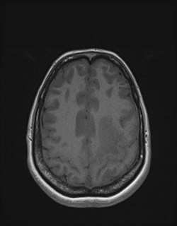 Central neurocytoma (Radiopaedia 84497-99872 Axial T1 149).jpg