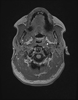 Central neurocytoma (Radiopaedia 84497-99872 Axial T1 22).jpg