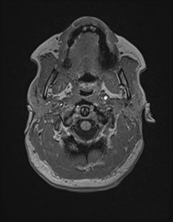 Central neurocytoma (Radiopaedia 84497-99872 Axial T1 23).jpg