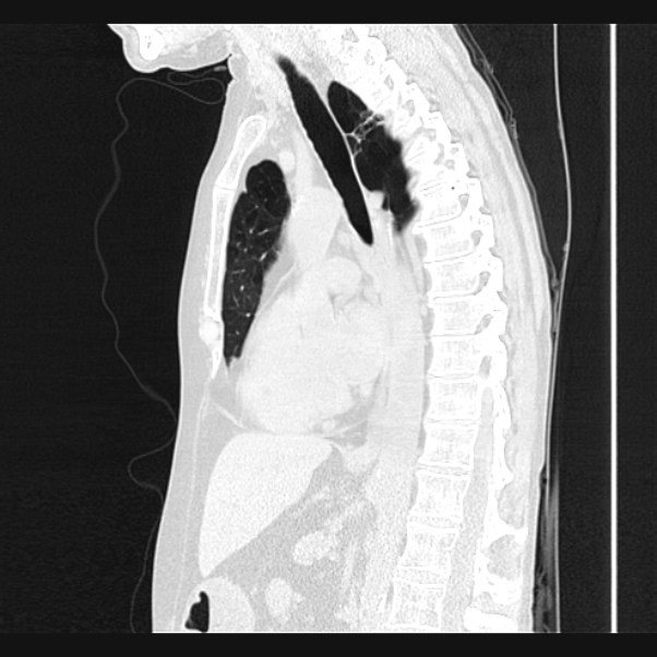 Centrilobular pulmonary emphysema (Radiopaedia 24495-24789 Sagittal lung window 42).jpg