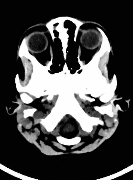 Cerebellar abscess (Radiopaedia 73727-84527 Axial non-contrast 21).jpg