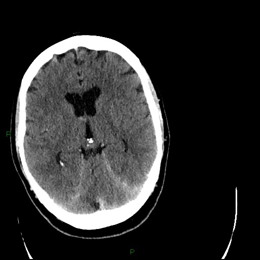Cerebellar abscess (Radiopaedia 78135-90671 Axial C+ delayed 53).jpg