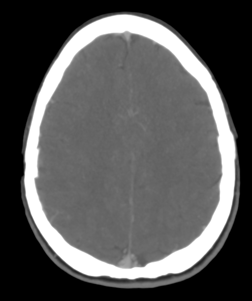 Cerebellar arteriovenous malformation- with hemorrhage (Radiopaedia 35752-37297 B 38).png