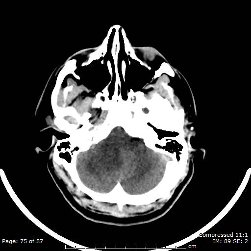 Cerebellar hemangioblastoma (Radiopaedia 52360-58258 Axial non-contrast 75).jpg