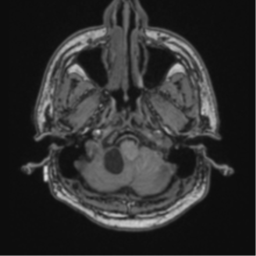 File:Cerebellar hemangioblastomas and pituitary adenoma (Radiopaedia 85490-101176 Axial T1 10).png
