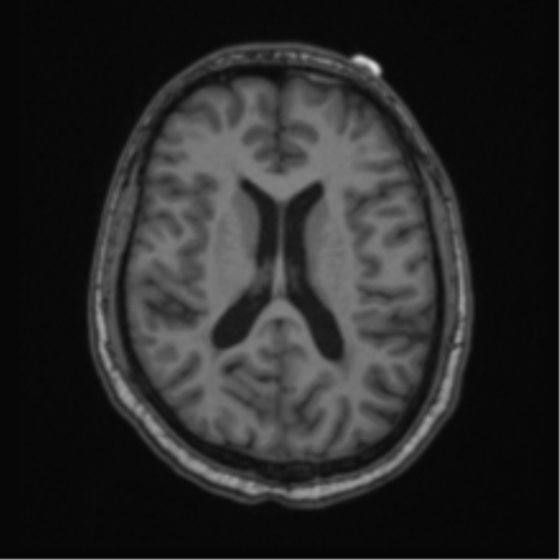Cerebellar hemangioblastomas and pituitary adenoma (Radiopaedia 85490-101176 Axial T1 44).png