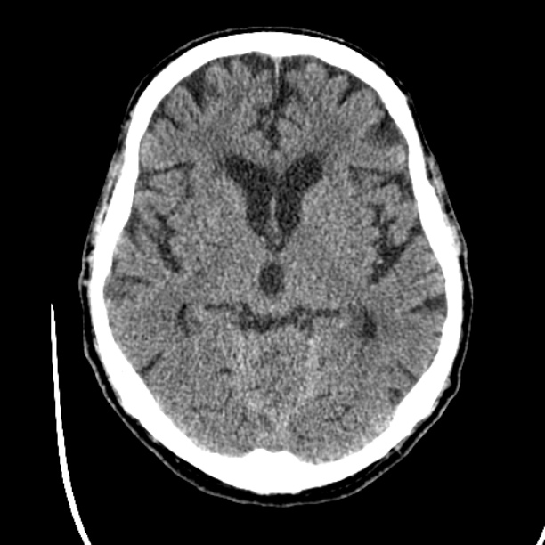 Cerebellar hemorrhage (Radiopaedia 27193-27359 Axial non-contrast 23).jpg