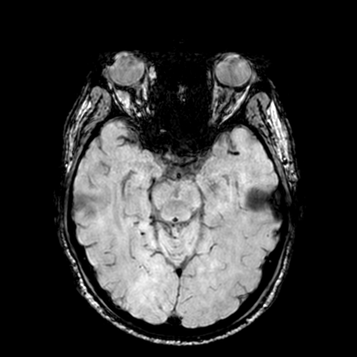 Cerebellar hemorrhage (Radiopaedia 37000-38666 Axial Gradient Echo 33).png