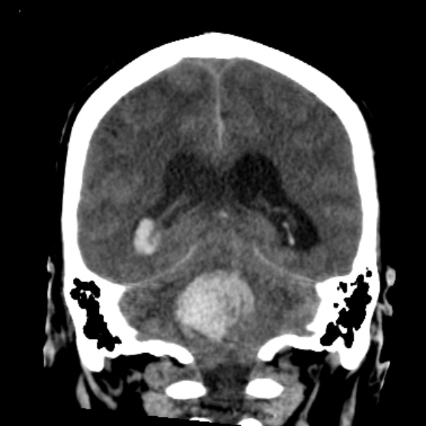 Cerebellar hemorrhage causing obstructive hydrocephalus (Radiopaedia 33989-35207 Coronal non-contrast 36).jpg