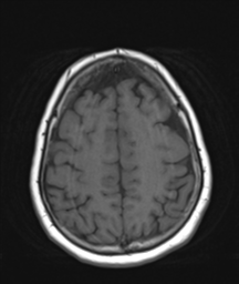 File:Cerebellar metastasis (Radiopaedia 54578-60810 Axial T1 30).png