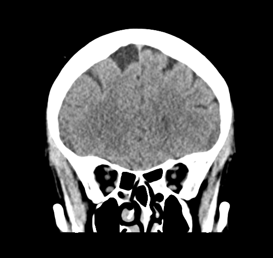 Cerebellar metastasis (Radiopaedia 54578-60812 Coronal non-contrast 15).png