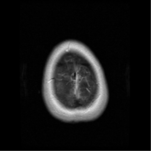 File:Cerebellar metastasis (cystic appearance) (Radiopaedia 41395-44262 Axial T1 C+ 21).png