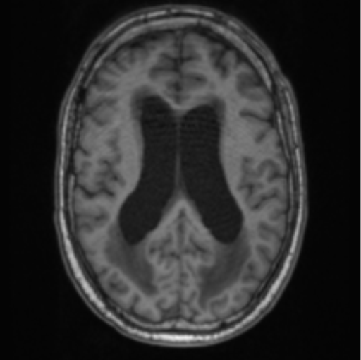 Cerebellar metastasis from lung adenocarcinoma (Radiopaedia 86690-102829 Axial T1 49).png