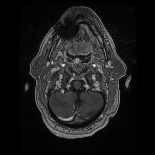 Cerebellar metastasis of pulmonary adenocarcinoma, cavernous venous malformation, and developmental venous anomaly (Radiopaedia 85827-101661 Axial T1 C+ 14).jpg