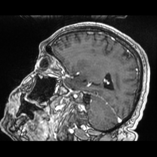 Cerebellar metastasis of pulmonary adenocarcinoma, cavernous venous malformation, and developmental venous anomaly (Radiopaedia 85827-101661 Sagittal T1 C+ 62).jpg