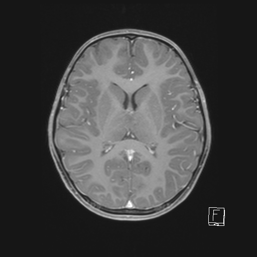 Cerebellar stroke (Radiopaedia 32202-33150 Axial T1 C+ 42).png