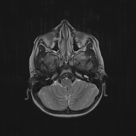 File:Cerebellar stroke (Radiopaedia 32202-33150 Axial T2 7).png