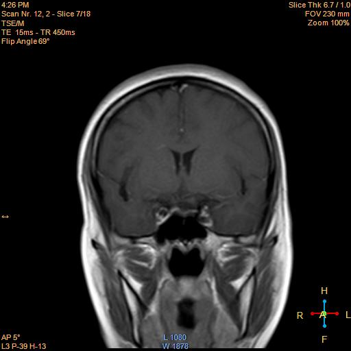 File:Cerebellopontine angle meningioma (Radiopaedia 22488-22525 Coronal T1 C+ 7).jpg