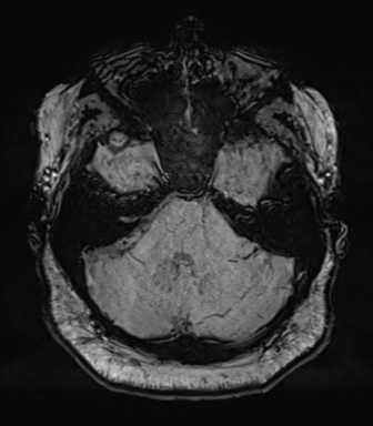 Cerebellopontine angle meningioma (Radiopaedia 48434-53348 Axial SWI 24).png