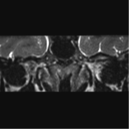 Cerebellopontine angle meningioma (Radiopaedia 48434-53348 Coronal T2 79).png