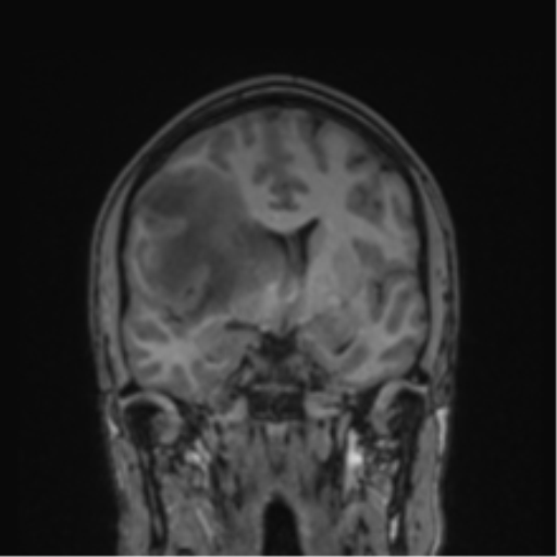 Cerebral abscess (Radiopaedia 60342-68009 Coronal T1 29).png