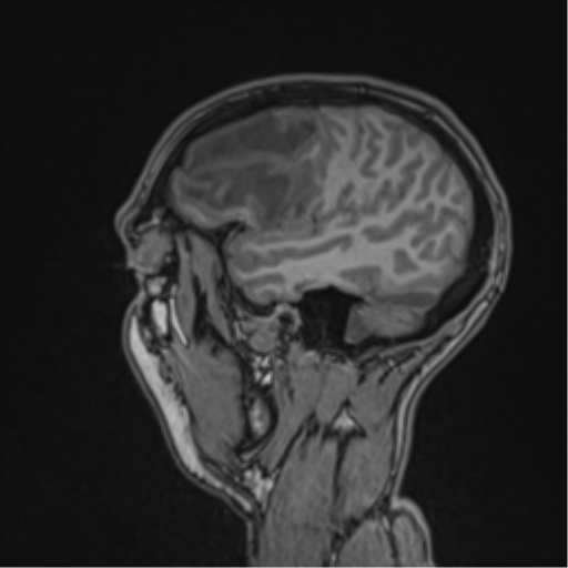 File:Cerebral abscess (Radiopaedia 60342-68009 Sagittal T1 45).png