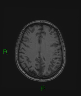 Cerebral abscess and subdural empyema (Radiopaedia 84436-99779 Axial T1 31).jpg