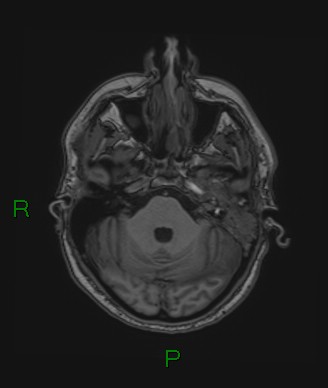 Cerebral abscess and subdural empyema (Radiopaedia 84436-99779 Axial T1 64).jpg