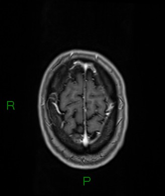 Cerebral abscess and subdural empyema (Radiopaedia 84436-99779 Axial T1 C+ 14).jpg