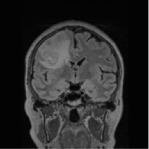 Cerebral abscess from pulmonary arteriovenous malformation (Radiopaedia 86275-102291 Coronal FLAIR 51).png