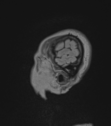 Cerebral abscess from pulmonary arteriovenous malformation (Radiopaedia 86275-102291 Sagittal FLAIR 7).png