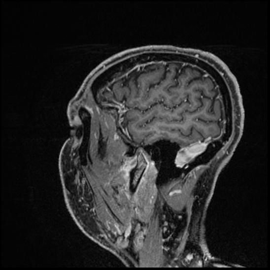Cerebral abscess with ventriculitis (Radiopaedia 78965-91878 Sagittal T1 C+ 150).jpg