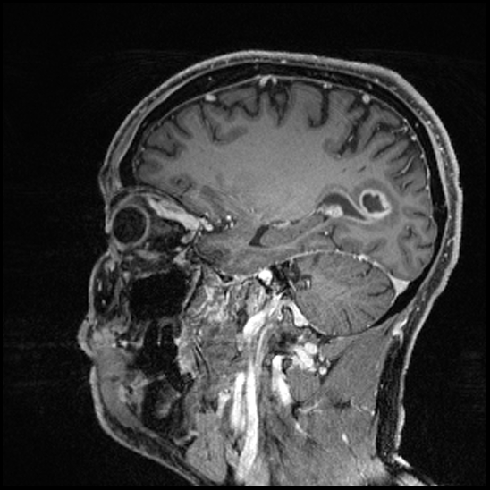 Cerebral abscess with ventriculitis (Radiopaedia 78965-91878 Sagittal T1 C+ 61).jpg