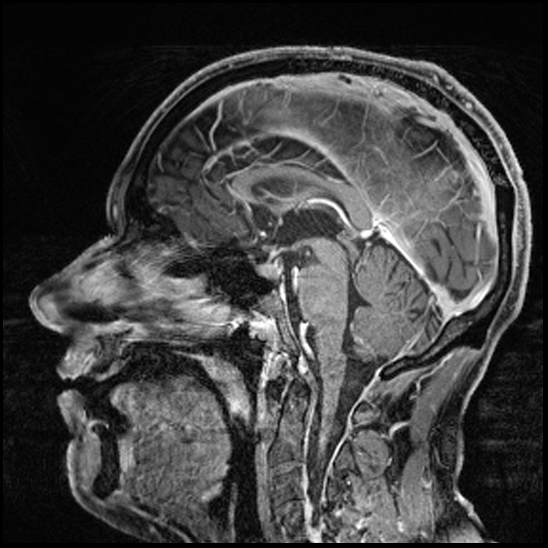 Cerebral abscess with ventriculitis (Radiopaedia 78965-91878 Sagittal T1 C+ 92).jpg