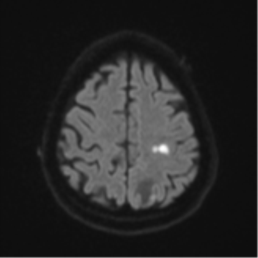 Cerebral abscesses- medically managed (Radiopaedia 45183-49179 Axial DWI 50).png