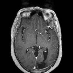 Cerebral amyloid angiopathy (Radiopaedia 29129-29518 Axial T1 C+ 70).jpg