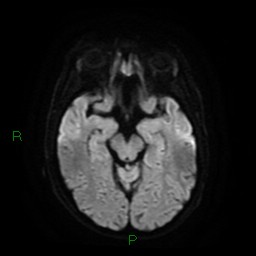 Cerebral amyloid angiopathy (Radiopaedia 77506-89664 Axial DWI 12).jpg