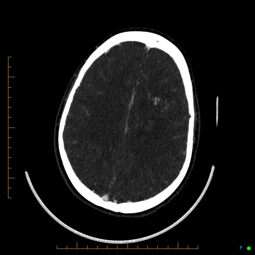Cerebral arteriovenous malformation (AVM) (Radiopaedia 78162-90706 Axial CTA 189).jpg