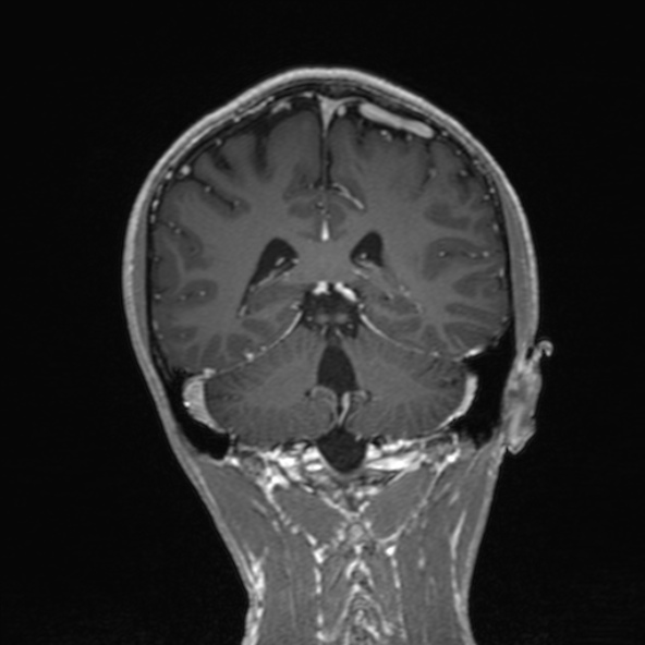 Cerebral arteriovenous malformation (Radiopaedia 30198-30813 F 39).jpg