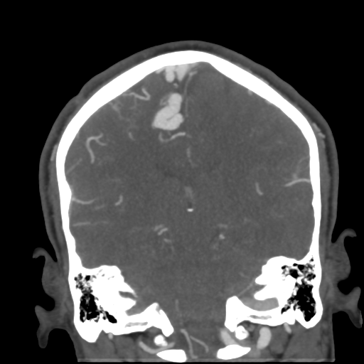 Cerebral arteriovenous malformation (Radiopaedia 39259-41505 E 42).png
