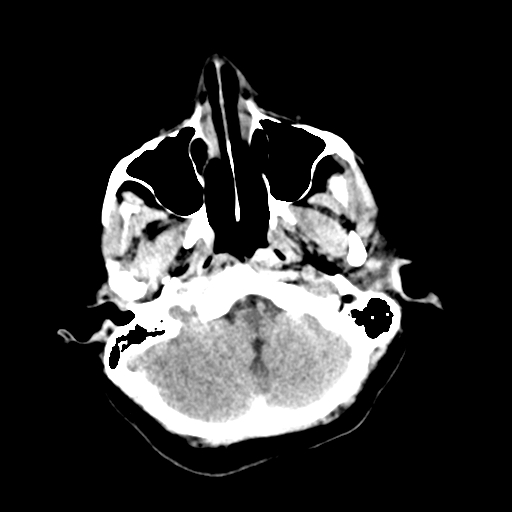 File:Cerebral arteriovenous malformation (Radiopaedia 73830-84645 Axial non-contrast 6).jpg