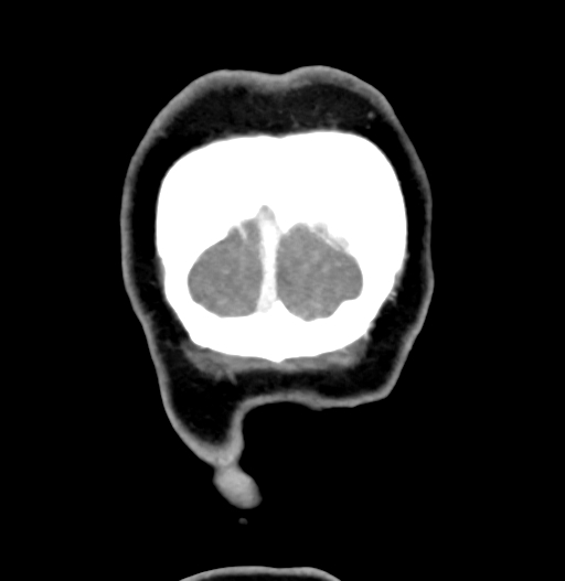 Cerebral arteriovenous malformation (Radiopaedia 73830-84645 C 94).jpg
