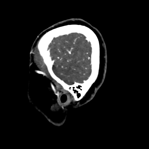 Cerebral arteriovenous malformation (Radiopaedia 73830-84645 Sagittal C+ delayed 8).jpg