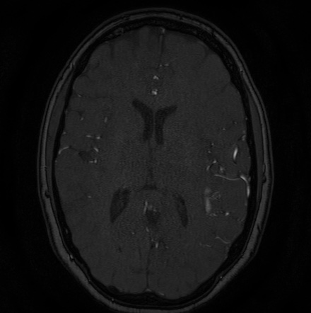 Cerebral arteriovenous malformation (Radiopaedia 74411-85654 Axial MRA 85).jpg