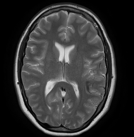 File:Cerebral arteriovenous malformation (Radiopaedia 74411-85654 Axial T2 16).jpg