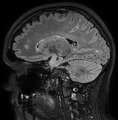 Cerebral arteriovenous malformation (Radiopaedia 74411-85654 Sagittal FLAIR 46).jpg