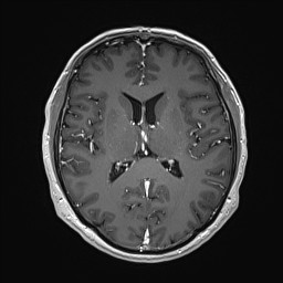 Cerebral arteriovenous malformation (Radiopaedia 84015-99245 Axial T1 C+ 88).jpg